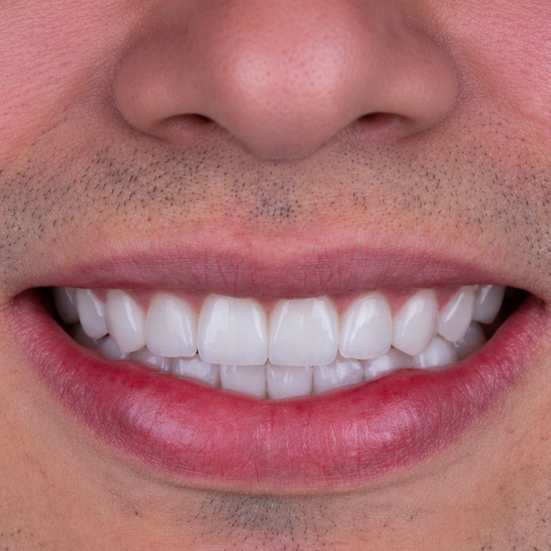 Sonrisa después del tratamiento, caso 1