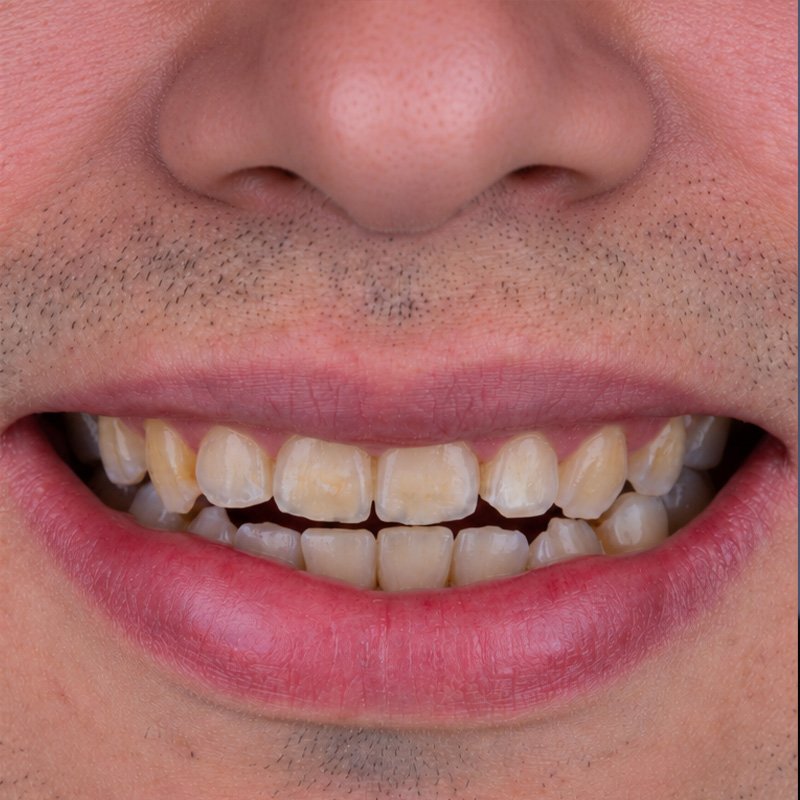 Sonrisa antes del tratamiento, caso 1
