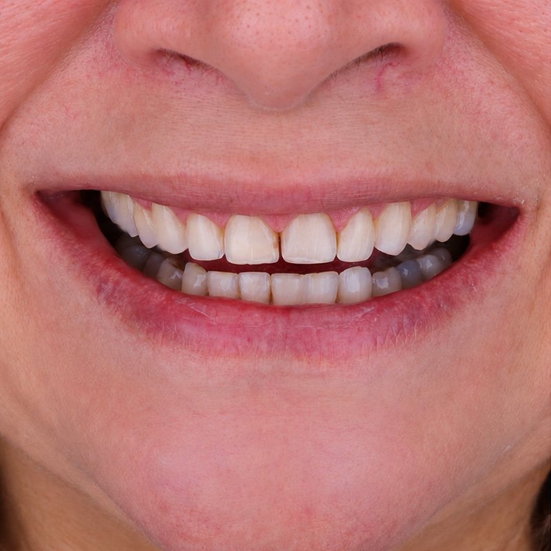 Sonrisa antes del tratamiento, caso 4