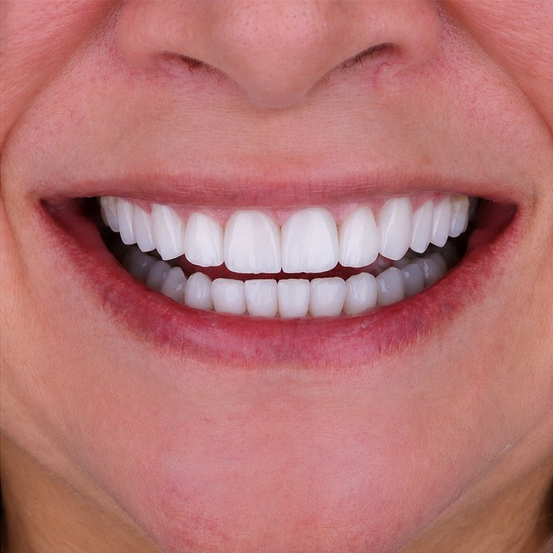 Sonrisa después del tratamiento, caso 4