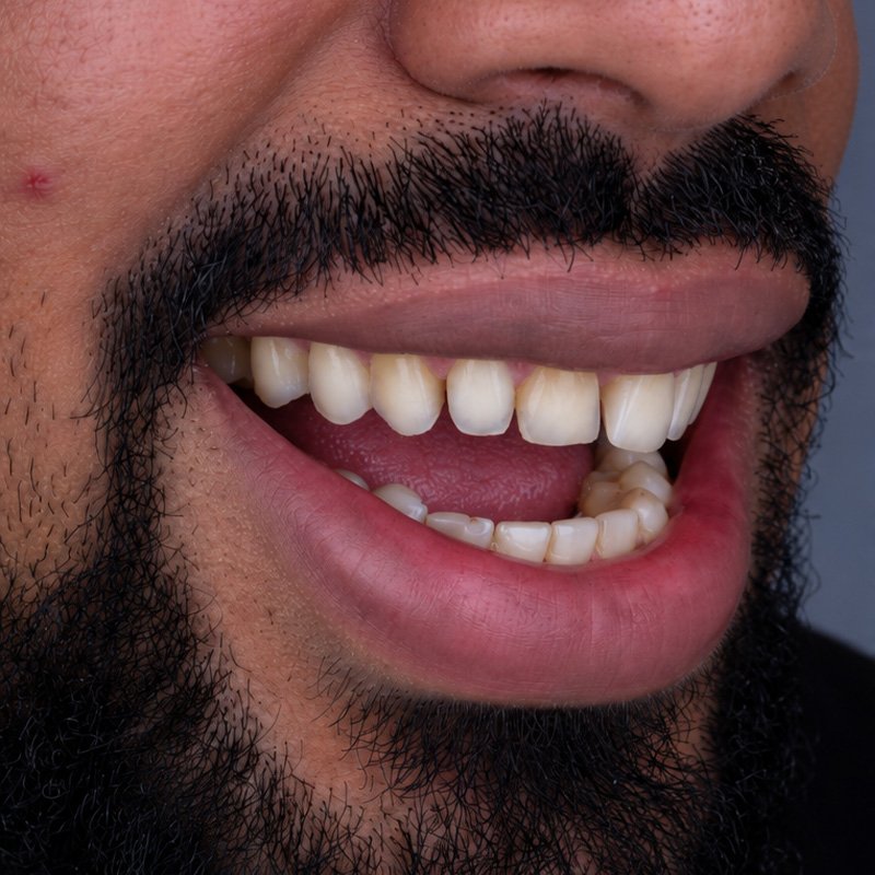 Sonrisa antes del tratamiento, caso 2