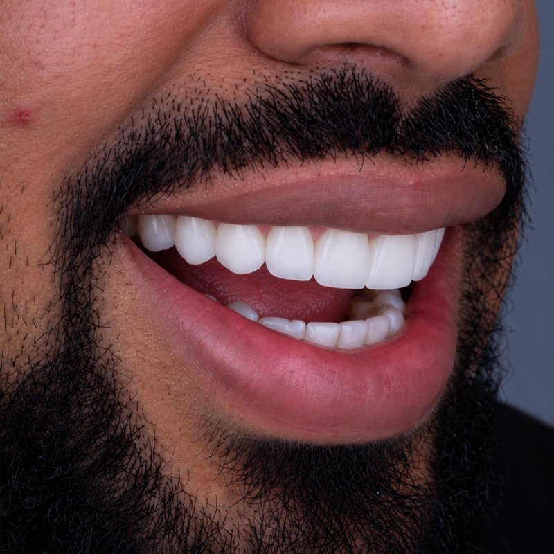 Sonrisa después del tratamiento, caso 2